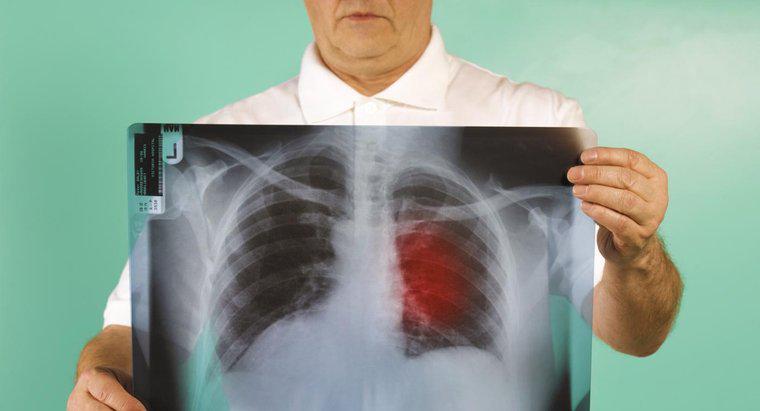 Qual è la prognosi per il cancro polmonare in stadio tre?