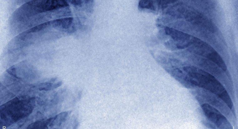 Cos'è il linfoma dei polmoni?