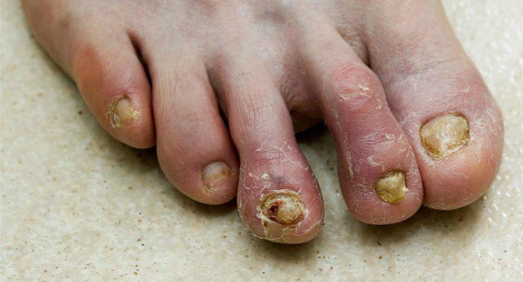 Quali sono i rimedi domestici per il fungo dell'unghia del piede?