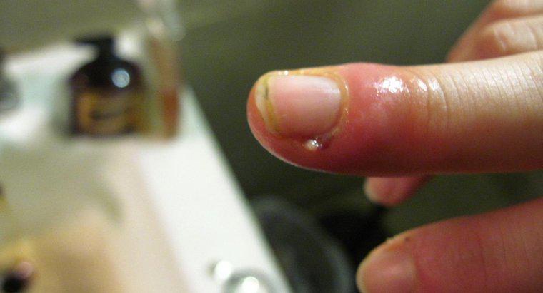 Che cosa deve fare una persona con un dito gonfio da una cuticola?