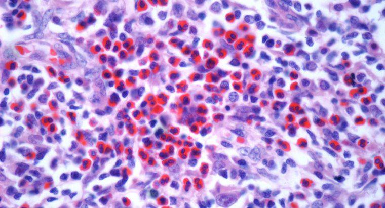 Cos'è il cancro al linfoma di stadio 3?