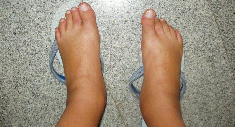Quali sono le cause dei piedi gonfiati?