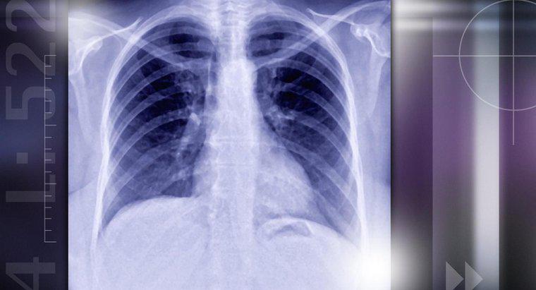 Quali sono i noduli polmonari?