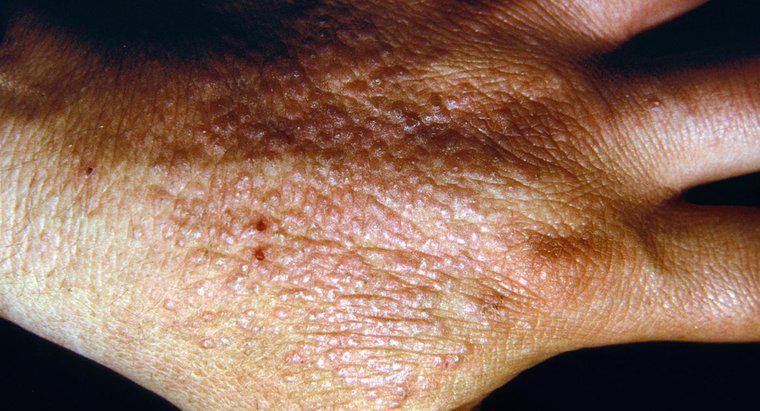 In che modo le persone contraggono la dermatite?