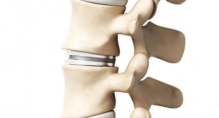 Quali sono le opzioni di trattamento per le vertebre schiacciate?
