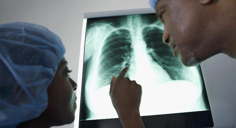 Quali sono le diverse opzioni di trattamento per il fluido sui polmoni?