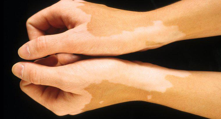 Quali sono i tipi di malattie della decolorazione della pelle?
