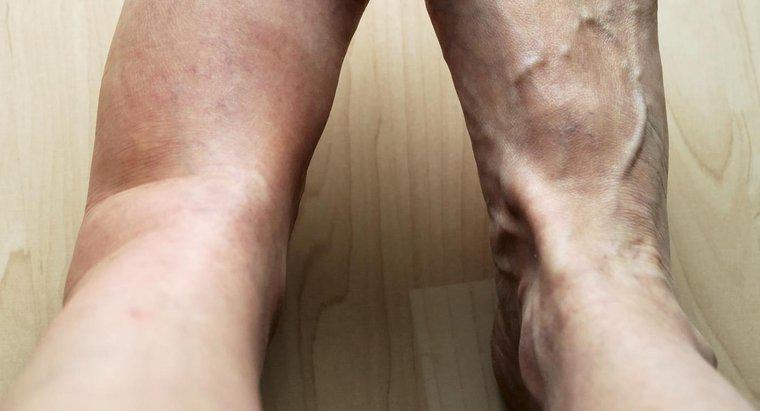 Quali sono alcune possibili cause di dolore e gonfiore nella gamba sinistra?