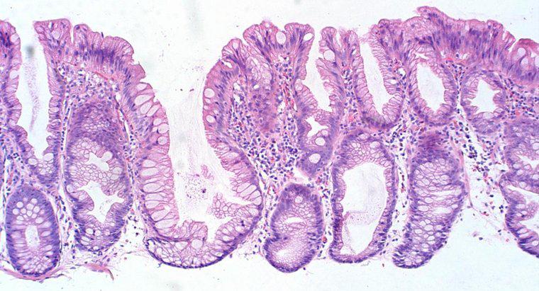 Che cosa causa i polipi del colon?