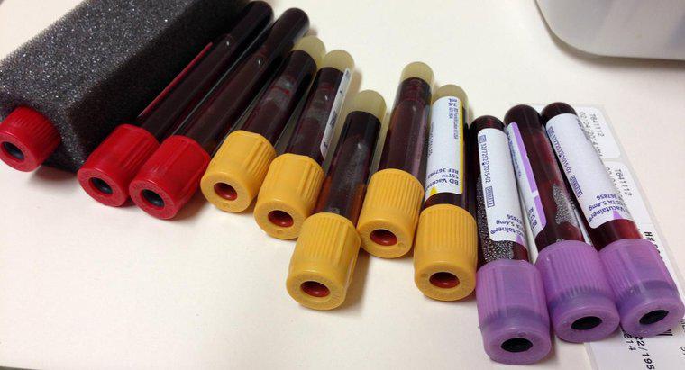 Cosa misurano i livelli di ferritina in un esame del sangue?