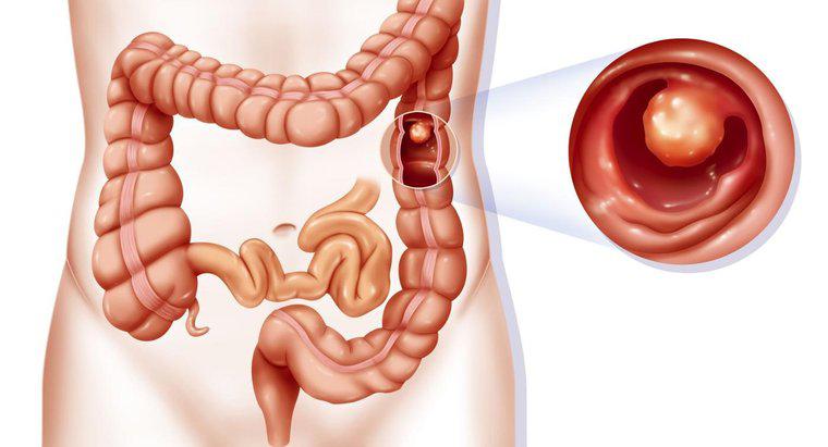 Cosa causa un blocco del colon?