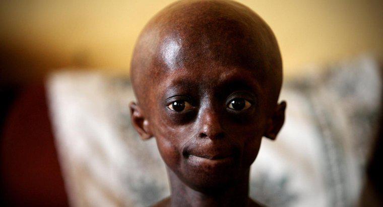 Quali limitazioni ha una persona con la progeria?