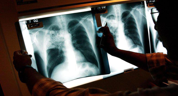 Quali sono gli effetti a lungo termine della tubercolosi?