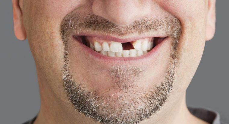 Quali sono i passaggi principali di una procedura di estrazione dei denti anteriori?