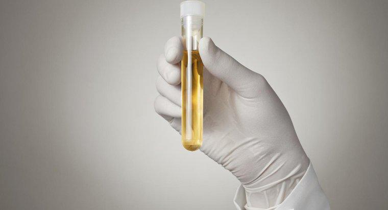 Che cosa significa quando hai un'alta percentuale proteica nelle urine?