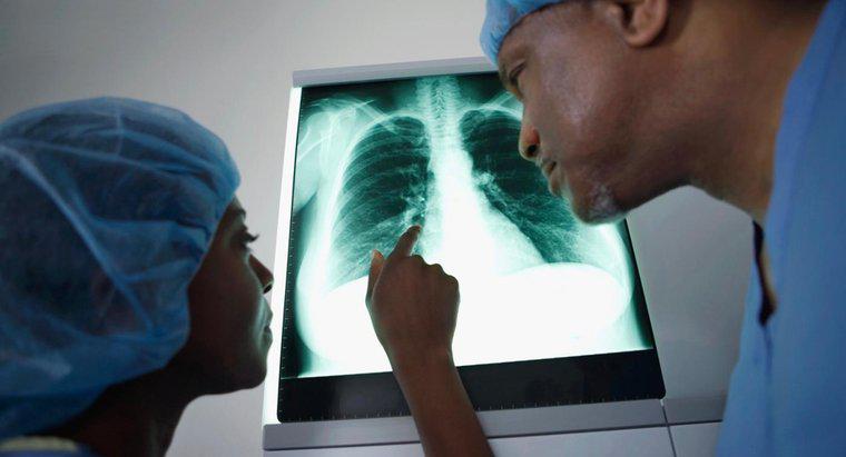 Quali sono i sintomi unici del cancro ai polmoni?