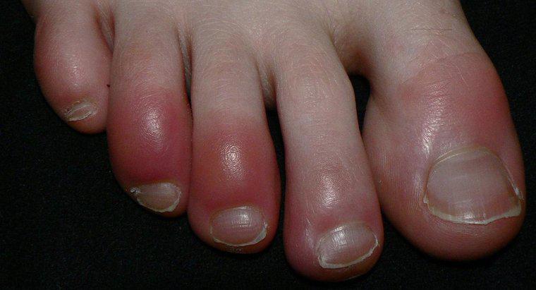 Red Toes è un sintomo della sindrome di Raynaud?