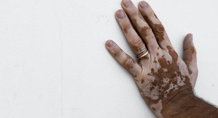 Come sbarazzarsi della decolorazione della pelle?
