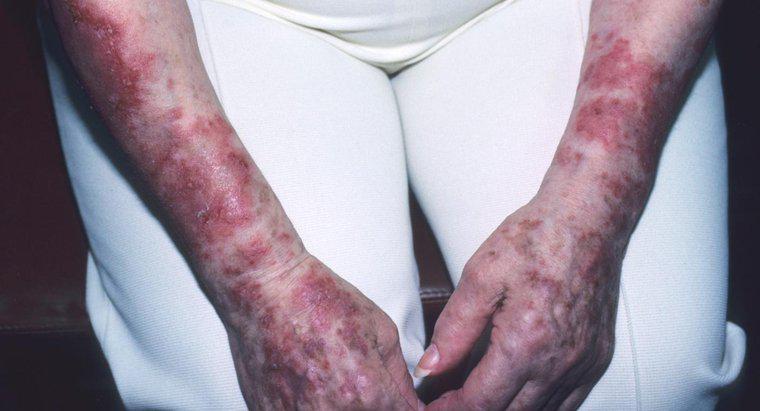 Come si diffonde il Lupus?