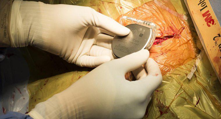 Qual è il processo di recupero per i pazienti con chirurgia pacemaker?