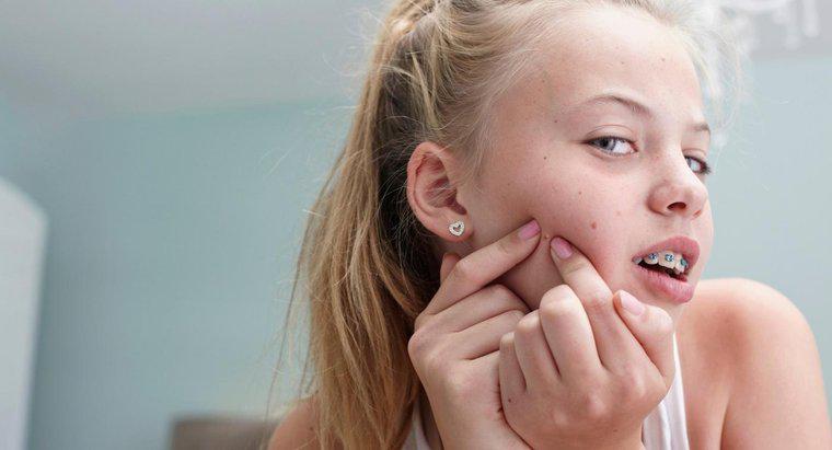 Come sbarazzarsi di acne?