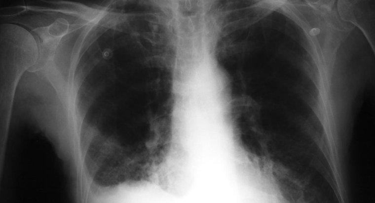 Cos'è la polmonite bronchiale?