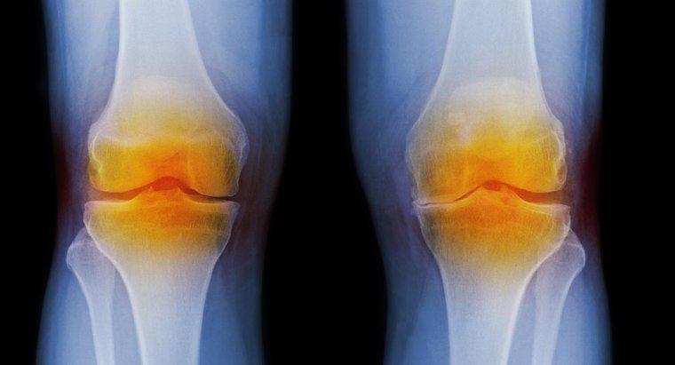 Quali sono i sintomi dell'artrite nel ginocchio?