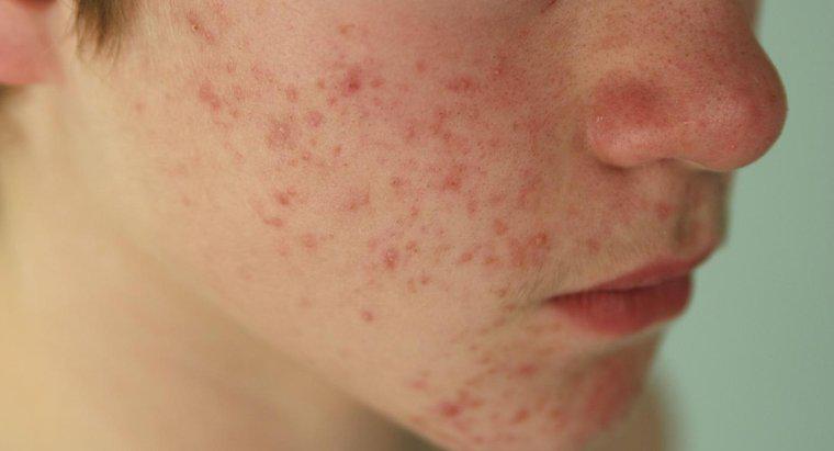 L'ipotiroidismo causa l'acne?