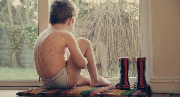 Quale parte del corpo interessa la varicella?
