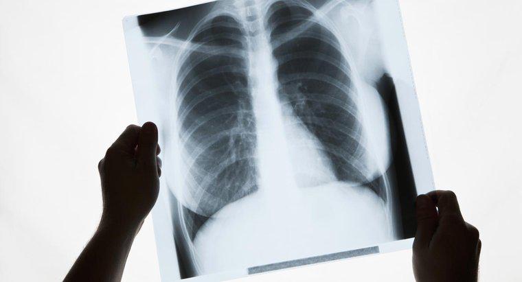 Che cosa provoca macchie bianche nei polmoni?
