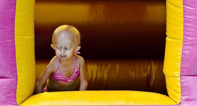 Quanto tempo puoi vivere con la Progeria?