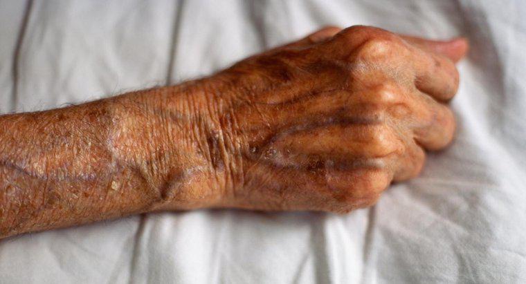 Che cosa causa il rigonfiamento delle vene nelle mani e nelle braccia?