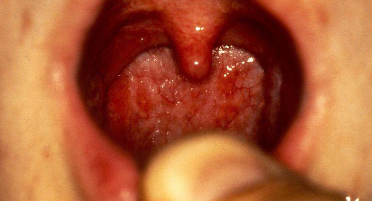 Quanto dura la faringite?