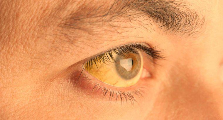 Quali sono le cause della pelle sotto gli occhi per ingiallire?