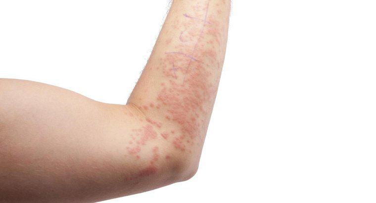 L'eczema assomiglia a tricofitosi?