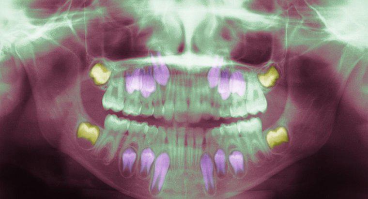Che cosa causa l'infezione del dente del giudizio?